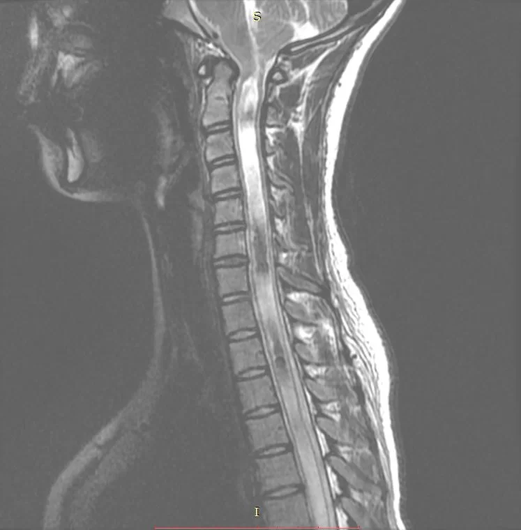 Σύνδρομο Chiari – Συριγγομυελία