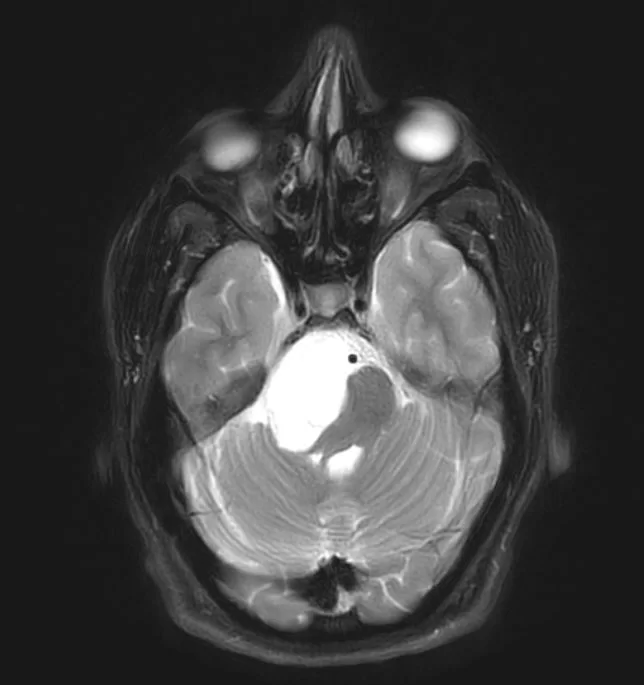 Επιδερμοειδής όγκος δεξιάς γεφυροπαρεγκεφαλιδικής γωνίας