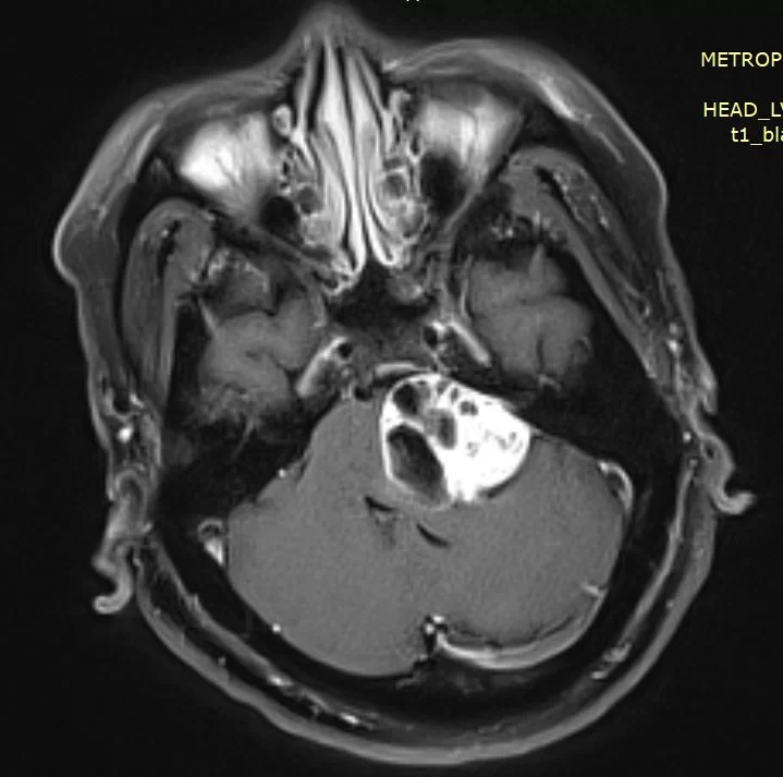 Ευμεγεθες Ακουστικό Νευρίνωμα με πίεση επί του εγκεφαλικού στελέχους