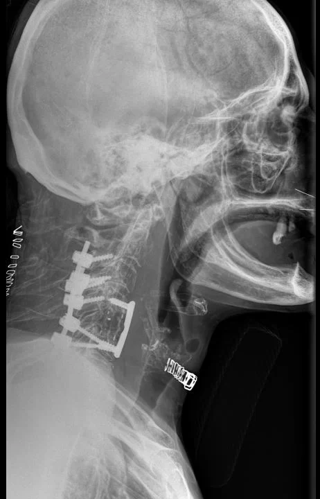 Πρόσθια – Οπίσθια (360ο) Σπονδυλοδεσία Αυχενικής Μοίρας Σπονδυλικής Στήλης