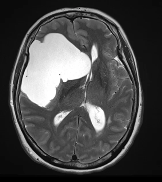 Αραχνοειδής Κύστη Εγκεφάλου