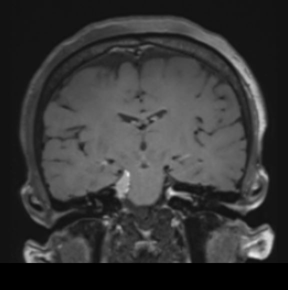 Αφαίρεση Μηνιγγιώματος Κορυφής Λιθοειδούς