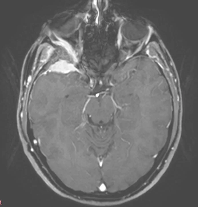 Μηνιγγίωμα Δεξιού Κόγχου