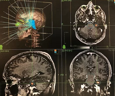 Ενδοκαναλικό Ακουστικό Νευρίνωμα αριστερά