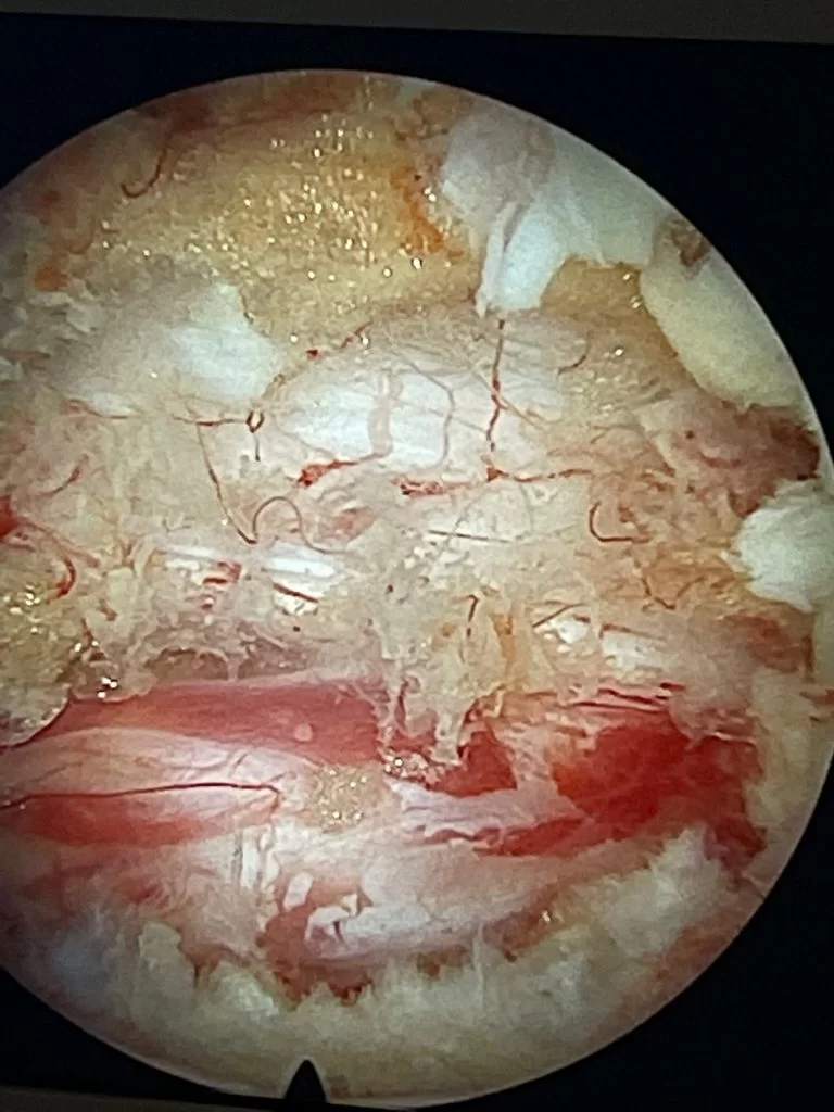 Ενδοσκοπική Αποσυμπίεση Σπονδυλικής Στένωσης Ο4/5