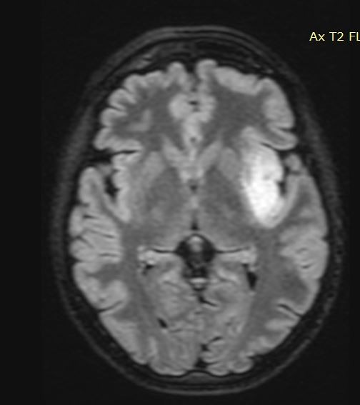 Αφαίρεση γλοιώματος σε κρίσιμη (λειτουργική – eloquent) περιοχή με την ασθενή ξύπνια