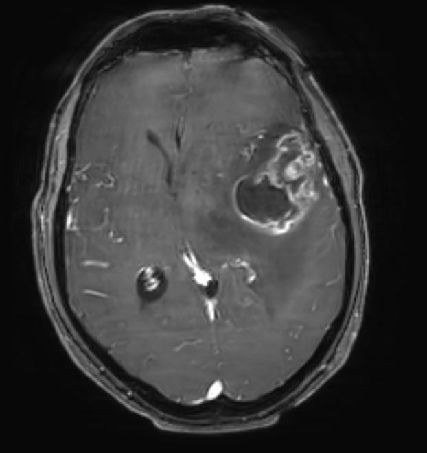 Σύγχρονη (State-of-the-art) αντιμετώπιση γλοιοβλαστώματος