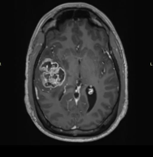 Χωροκατακτητική Εξεργασία δεξιού Κροταφικού Λοβού