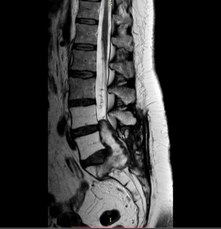 Όγκος Ιερού Οστού (Σβάννωμα)
