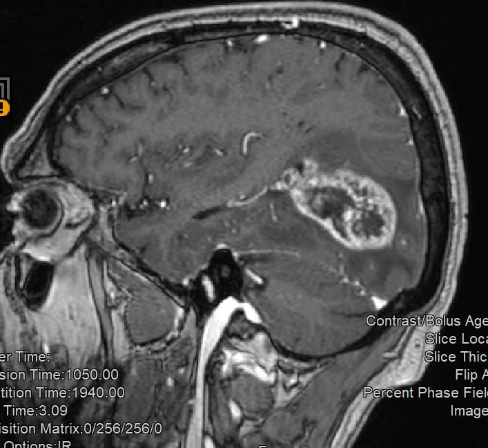 Γλοιοβλάστωμα Ινιακά αριστερά – Ολική εξαίρεση με τη χρήση 5-ALA