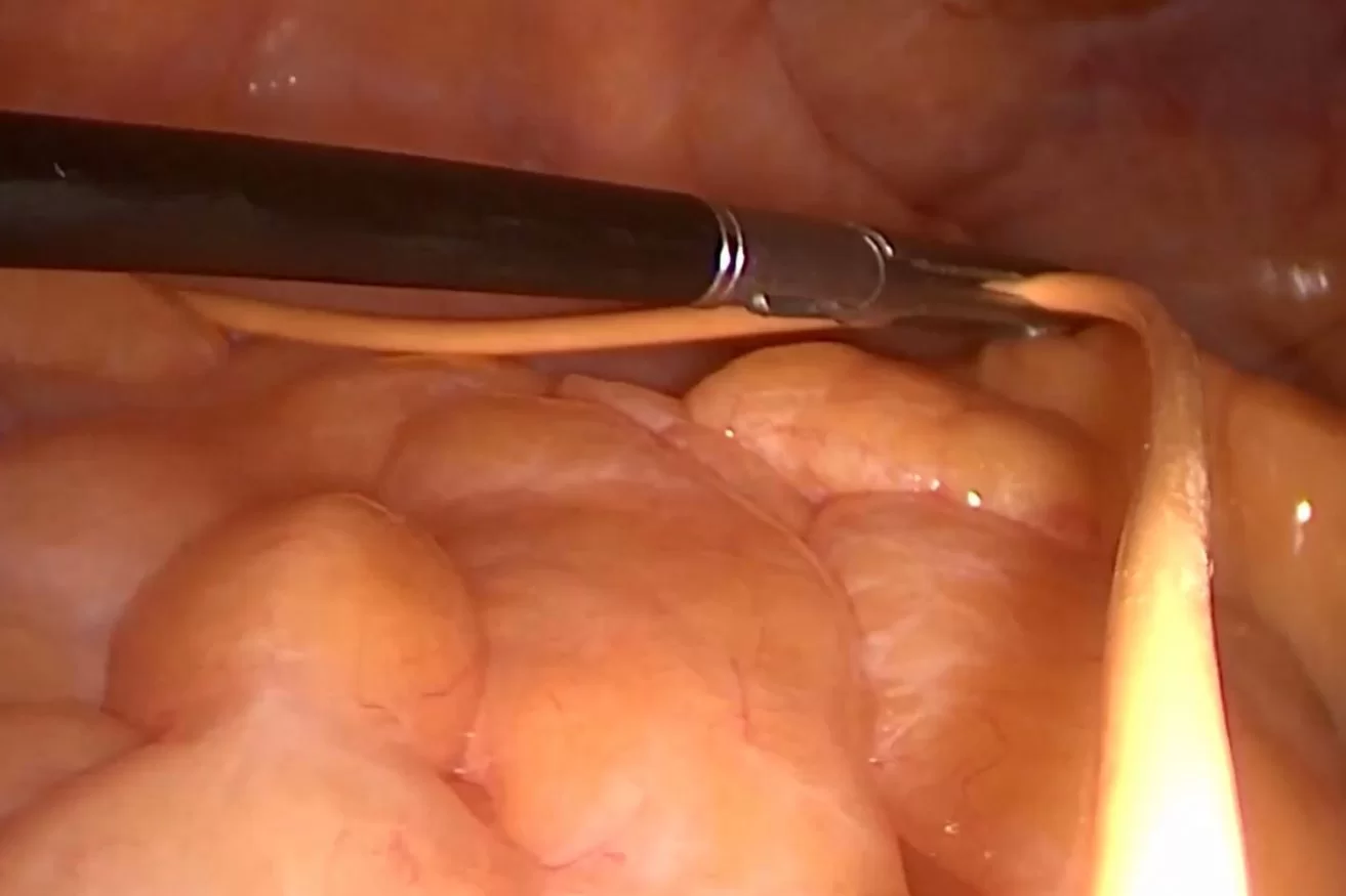 Υδροκέφαλος Φυσιολογικής Πίεσης – Λαπαροσκοπική τοποθέτηση περιφερικού καθετήρα