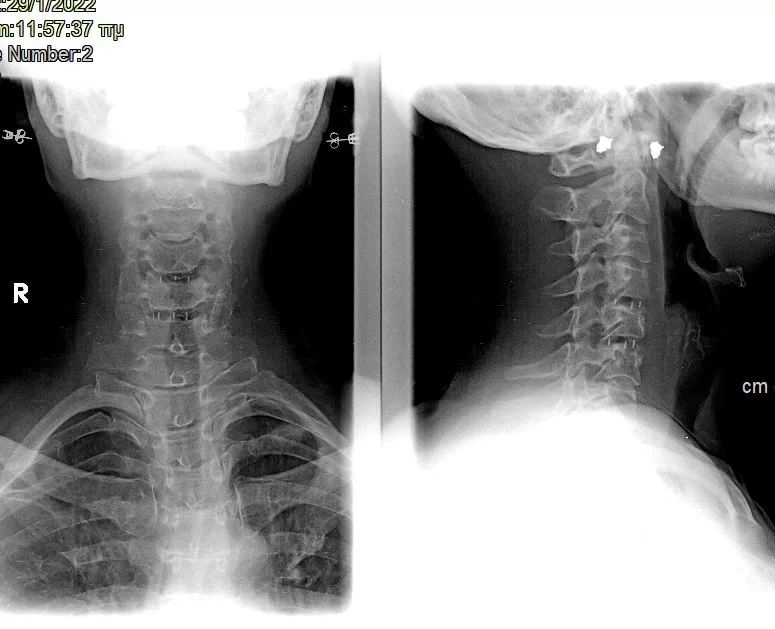 Κήλες Αυχενικής Μοίρας (Α5/6 & Α4/5) – Πρόσθια Δισκεκτομή