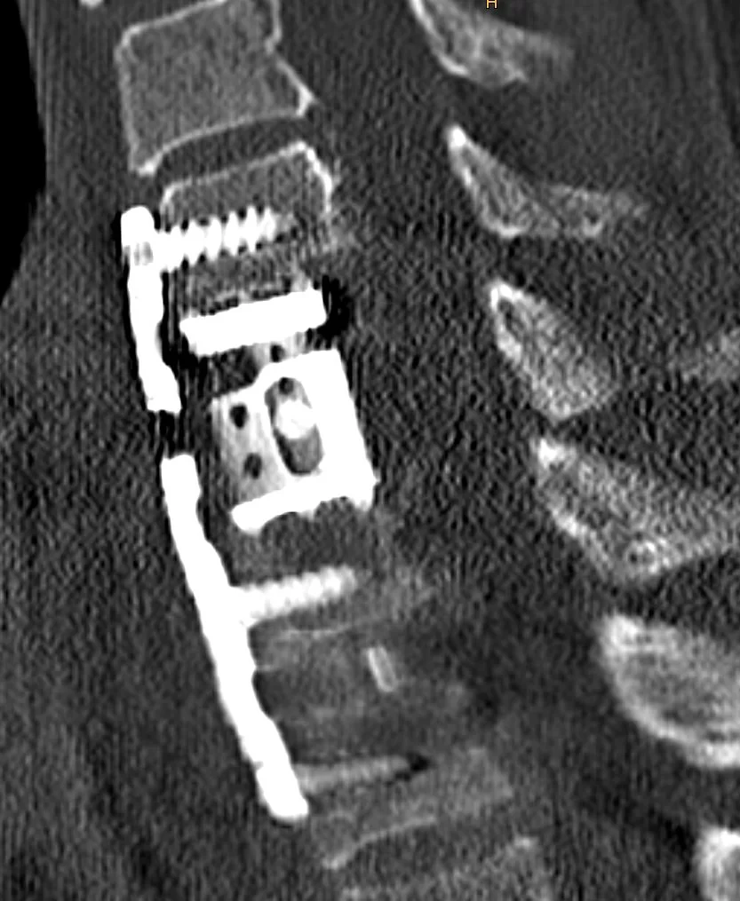 Σωματεκτομή Α6 Σπονδύλου