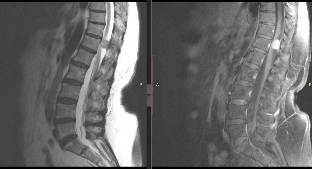 Μηνιγγίωμα Σπονδυλικής Στήλης (Θ12 σπονδύλου)- Πεταλοπλαστική, ολική αφαίρεση