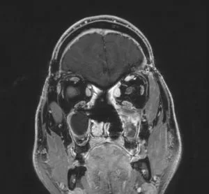 Αισθησιονευροβλάστωμα (οσφρητικό νευροβλάστωμα)