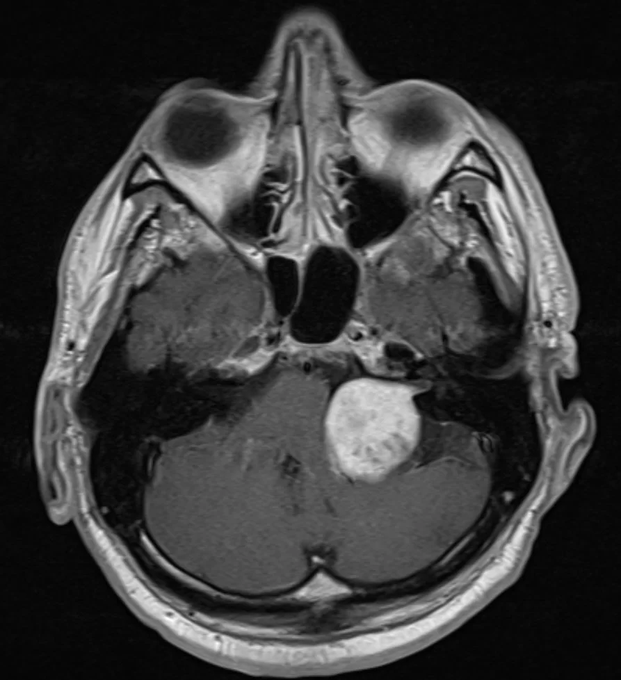 Ακουστικό Νευρίνωμα αριστερά