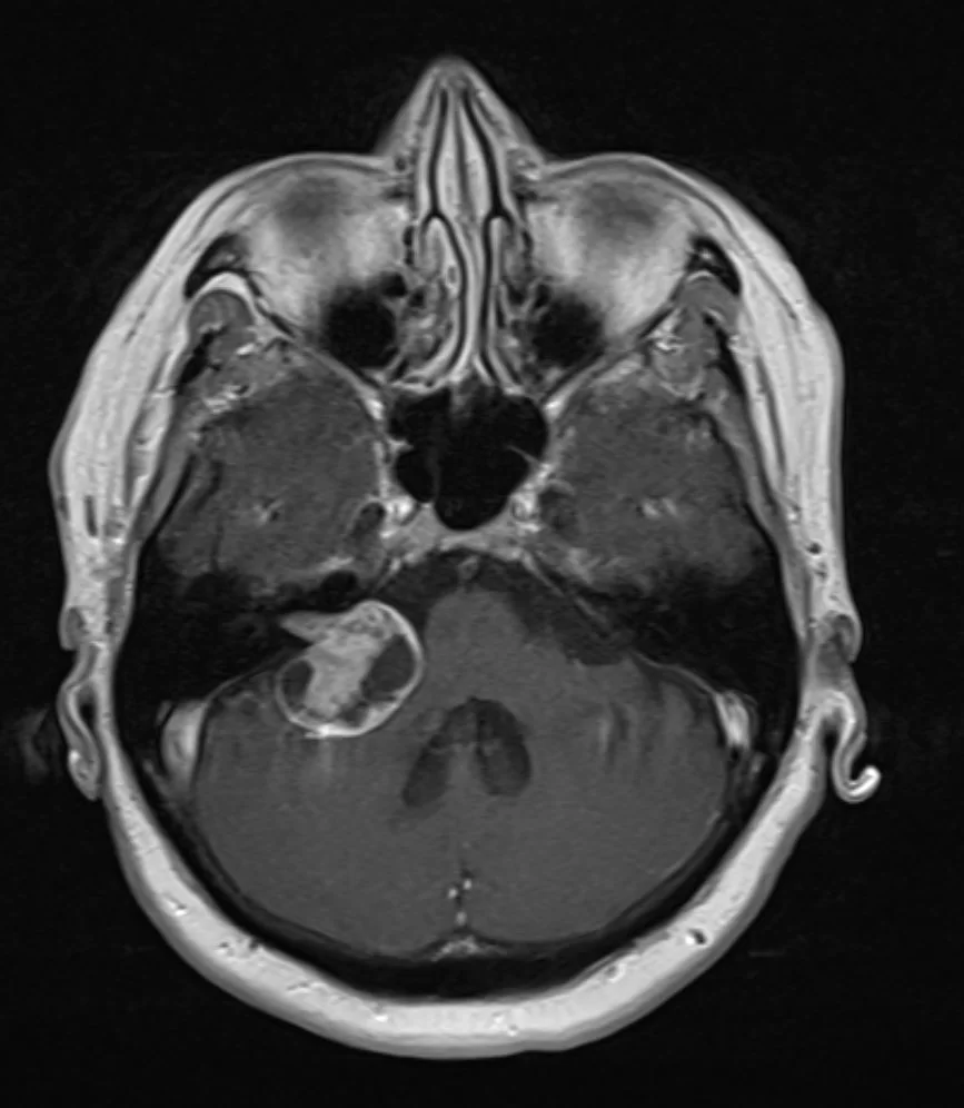 Ακουστικό Νευρίνωμα Δεξιά