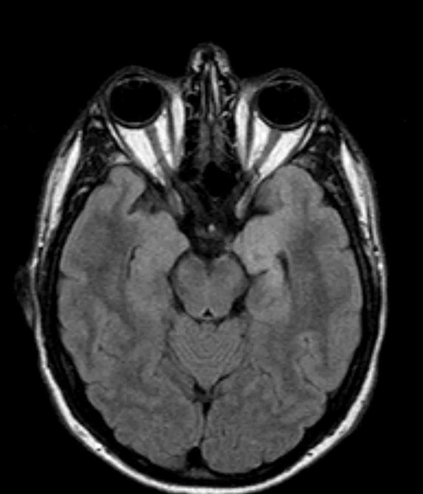 Γαγγλιογλοίωμα Ιπποκάμπου αριστερά