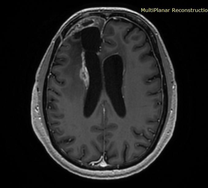 Αντιμετώπιση πιθανής υποτροπής γλοιοβλαστώματος με λειζερ (LITT)
