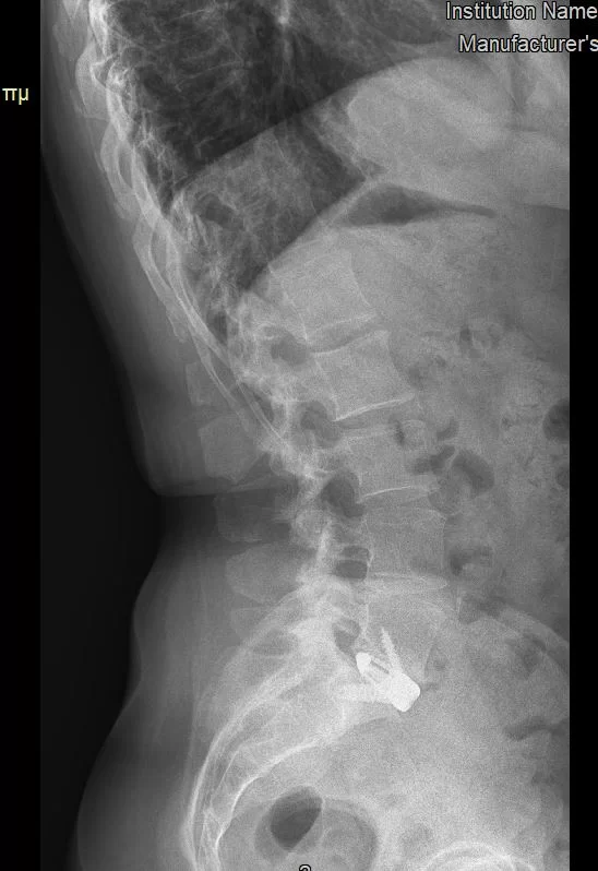 Πρόσθια (ALIF) Σπονδυλοδεσία Ο5/Ι1