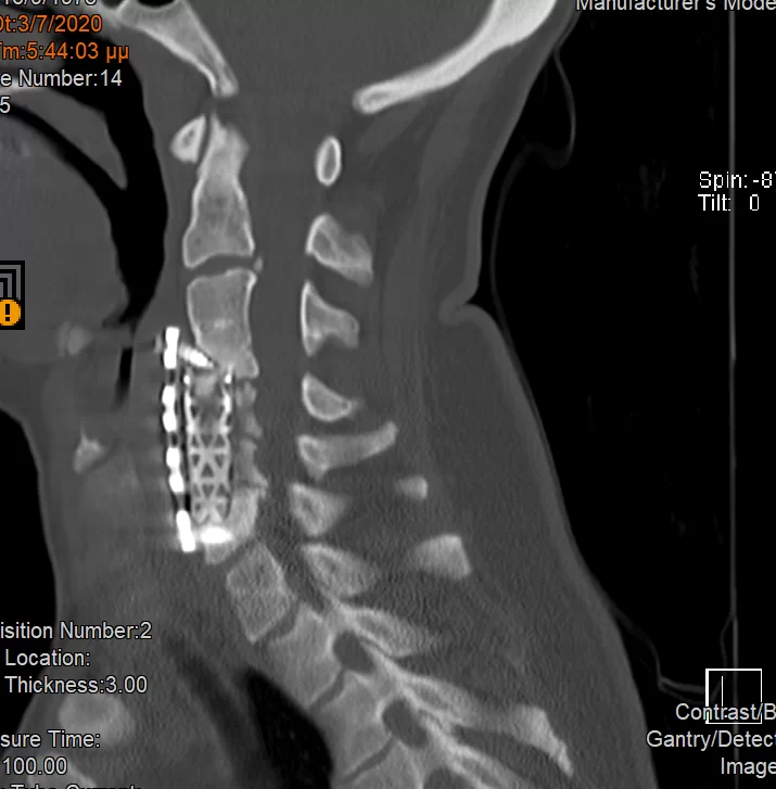 Ψευδάρθρωση μετά από σωματεκτομή Α5 & Α6 – Σπονδυλοδεσία ΑΜΣΣ 360ο