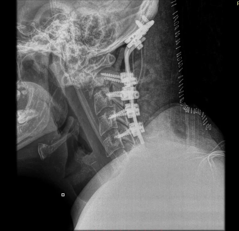 Ινιοαυχενική Σπονδυλοδεσία