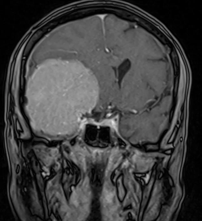 Ευμεγεθες Μηνιγγίωμα Πτέρυγας Σφηνοειδούς οστού