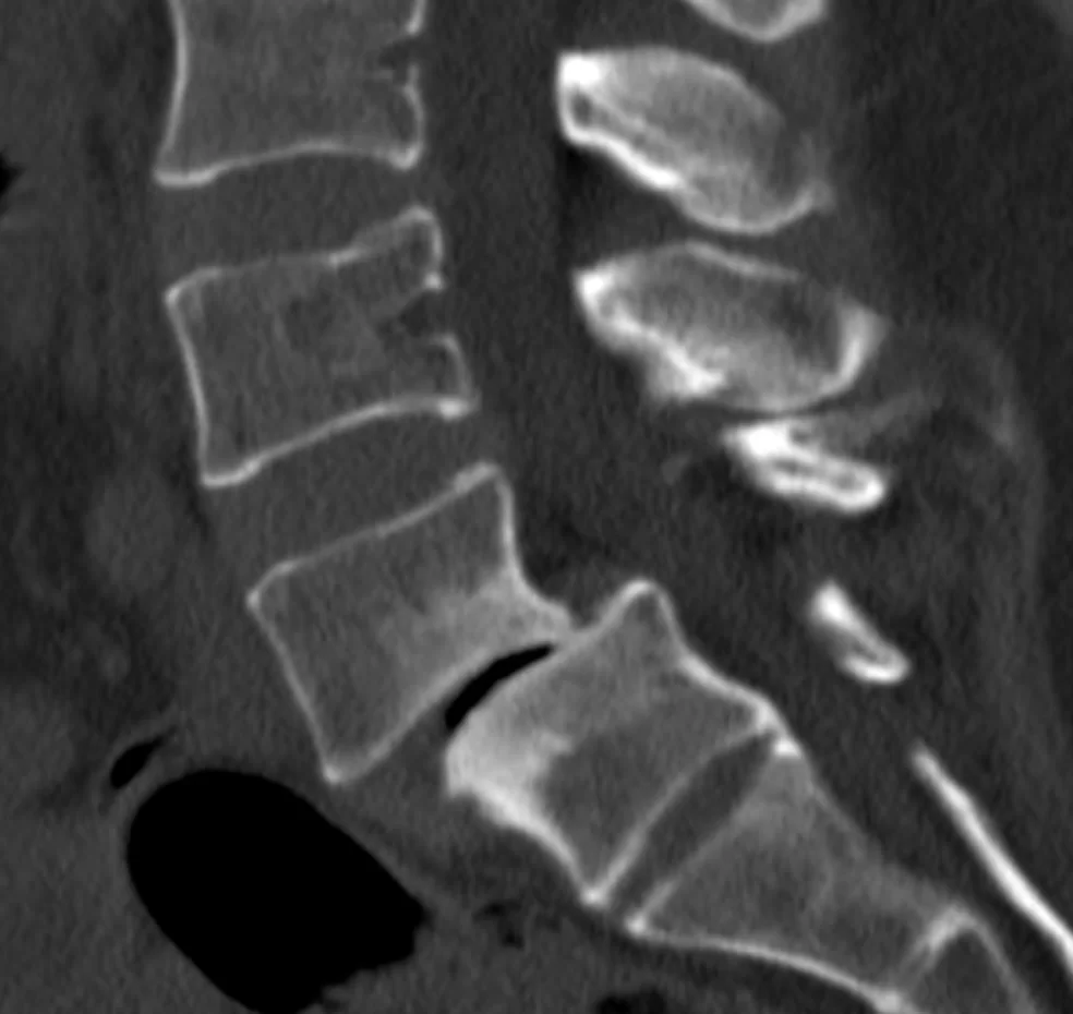 Διαδερμική (ελάχιστα επεμβατική) σπονδυλοδεσία Ο4-Ο5
