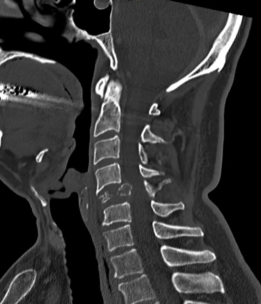 Παραγαγγλίωμα Α5 Σπονδύλου – Σωματεκτομή
