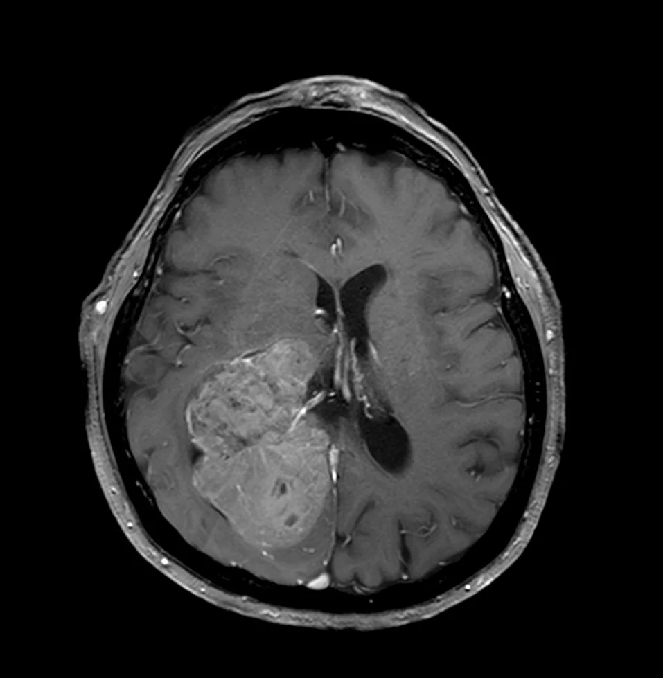 Ευμεγέθες Ενδοκοιλιακό Μηνιγγίωμα Δεξιά