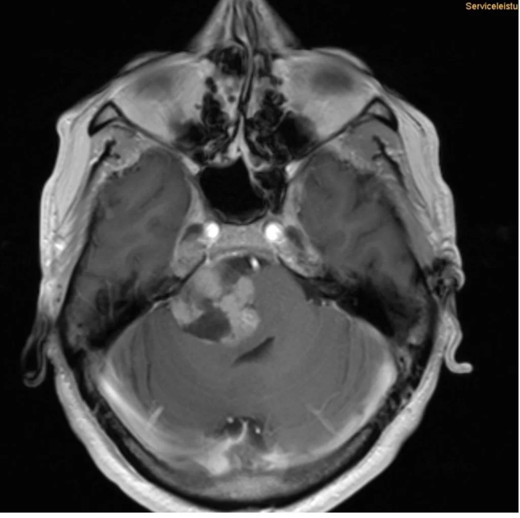 Μηνιγγίωμα γεφυροπαρεγκεφαλιδικής γωνίας δεξιά