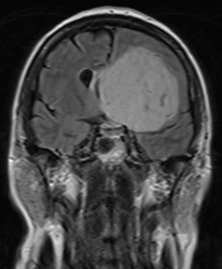 Μηνιγγίωμα της πτέρυγας του σφηνοειδούς οστού