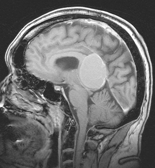 Μηνιγγίωμα περιοχής Επίφυσης