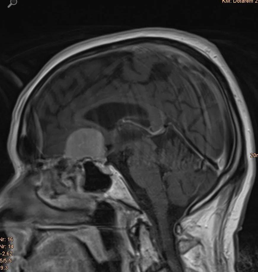 Μηνιγγίωμα φύματος εφιππίου – Υπερκόγχιος Κρανιοτομία