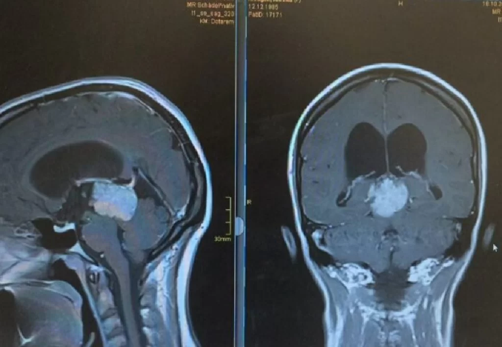 Πινεαλοκύττωμα