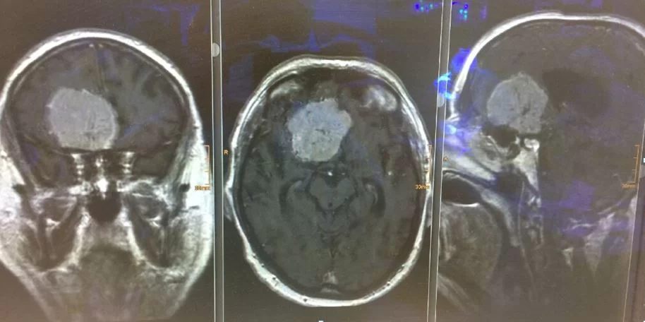 Υπερκόγχιος Κρανιοτομία