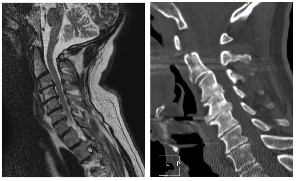 Αυχενική Δισκεκτομή σε 3 Επίπεδα