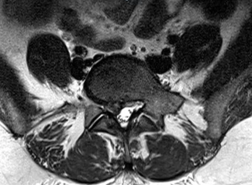 Ελάχιστα Επεμβατική Δισκεκτομή Ο4/5 δεξιά