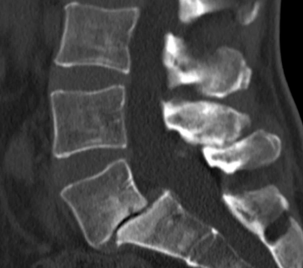 Διαδερμική (ελάχιστα επεμβατική) Σπονδυλοδεσία Ο5/Ι1