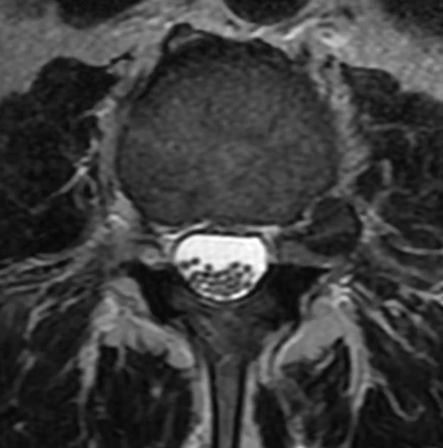Εξωτρηματική (πλάγια) δισκοκήλη O4-Ο5 αριστερά