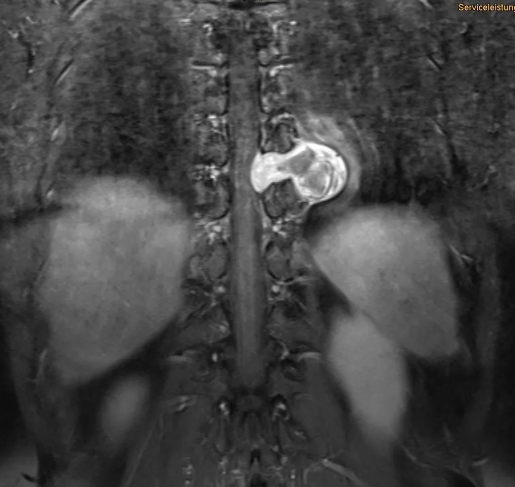 Θωρακικό Σβάννωμα Θ9/Θ10