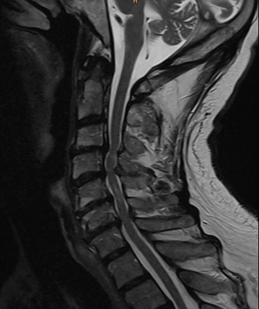 Οπίσθια Αυχενική Αποσυμπίεση και Σπονδυλοδεσία