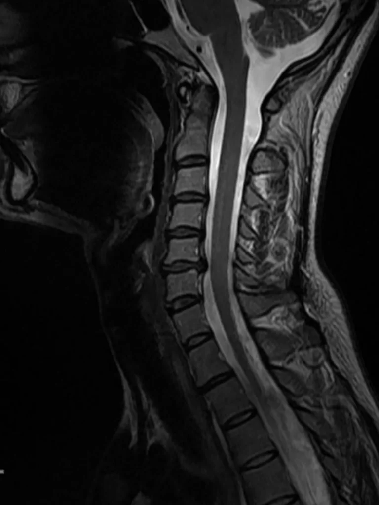 Τεχνητός δίσκος Α5/6