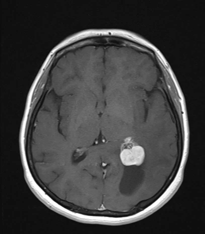 Ενδοκοιλιακό Μηνιγγίωμα