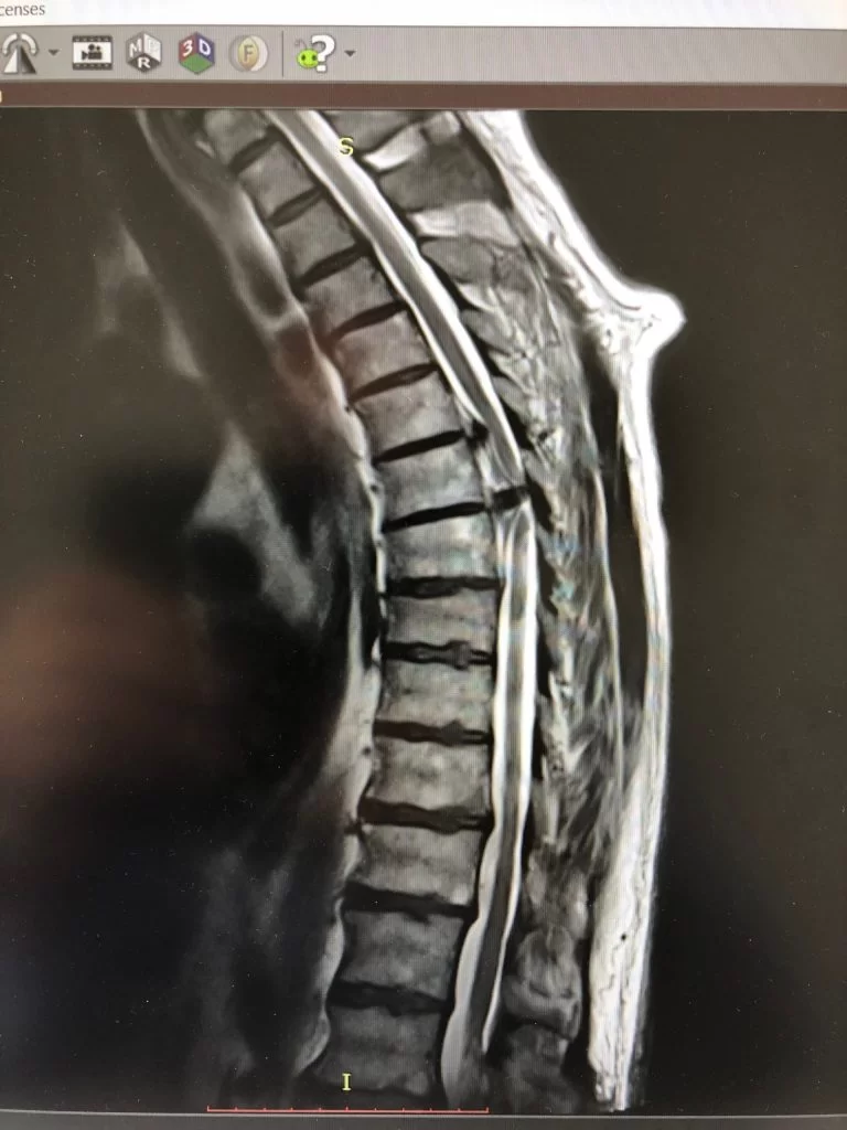 Θωρακικές Δισκοκήλες Θ6/7 και Θ7/8