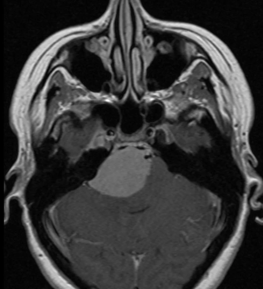 Μηνιγγίωμα Λιθοειδούς-Αποκλιματος (Petroclival)