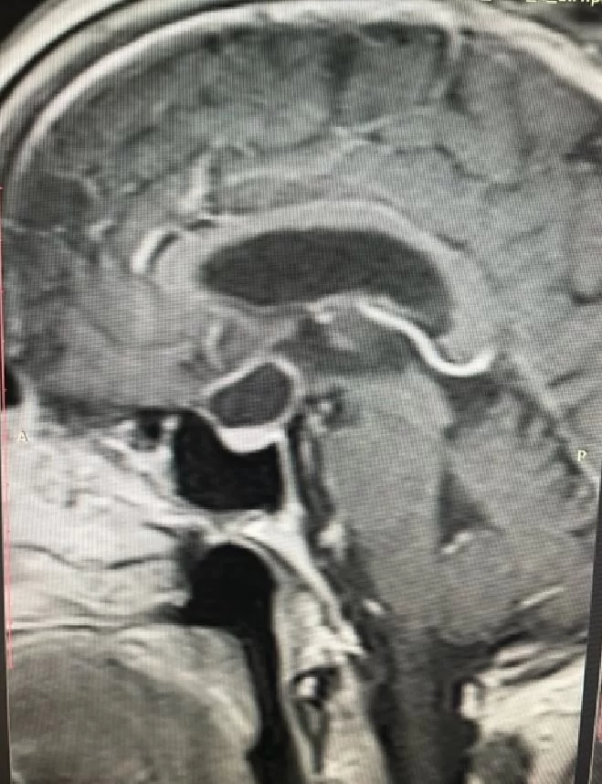 Ενδοσκοπική Διαρρινική Αφαίρεση Κρανιοφαρυγγιώματος