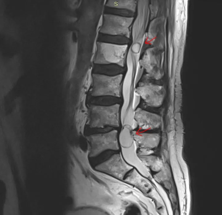 Πολλαπλά σβαννώματα (Νευρινώματα) οσφυϊκής μοίρας σπονδυλικής στήλης