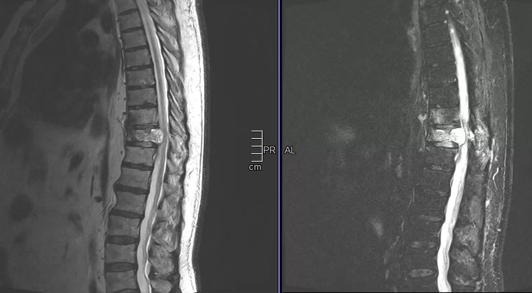 Μετάσταση 10ου Θωρακικού Σπονδύλου (Θ10)